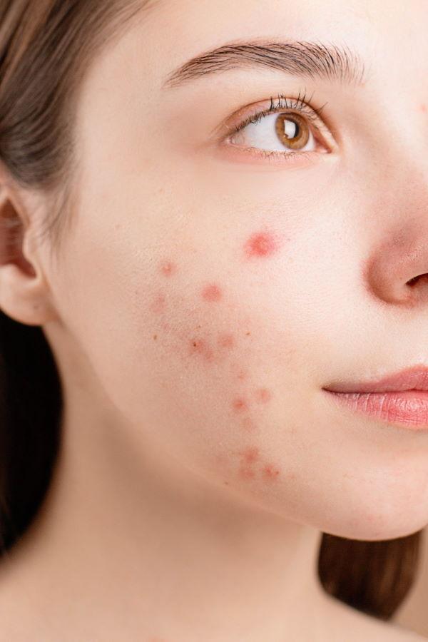 How To Defeat Hormonal Acne (Exposed Protects Barrier)