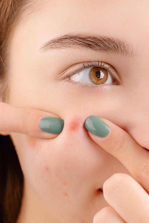 How To Pop A Pimple Responsibly (Only With This From Exposed)
