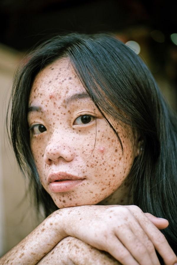 Best Acne Treatment For Teens (That Actually Works—Exposed)