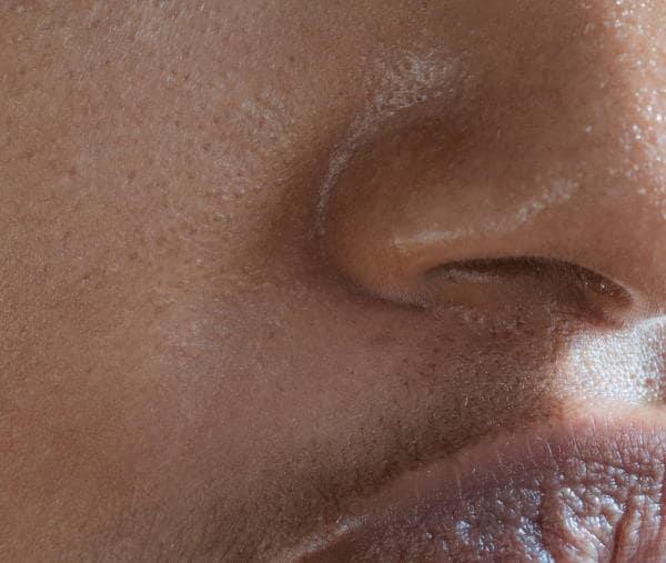 Fast Acting Treatment Plan For Nose Acne (Use Exposed Tonight)