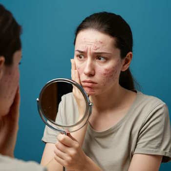 Effective Treatments for Acne Rosacea