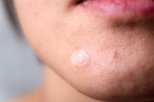 How Long To Leave Hydrocolloid On Acne? (Use Exposed Tips)