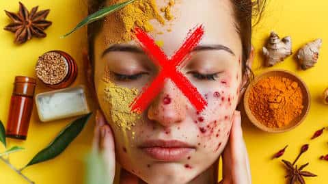 Why Ayurvedic Treatment for Acne Is A Bad Idea