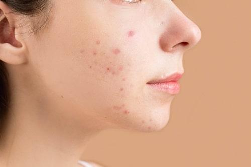 Acne Under Skin? (Clear It Without Popping—Use Exposed)