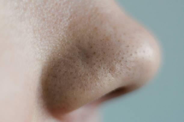 Closed Comedonal Acne Treatment (Finally Smooth With Exposed)