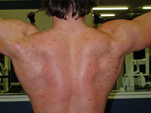 The Best Solution for Steroid Acne