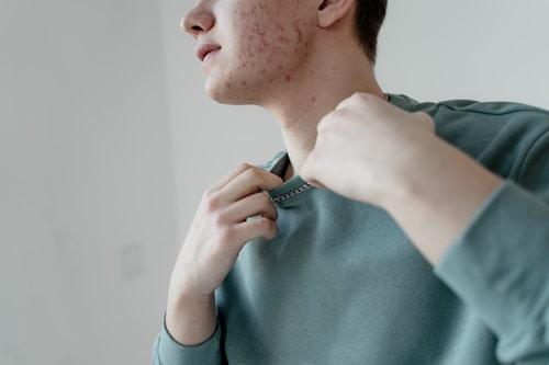 What Are Acne Blemishes? (Everything You Need to Know)