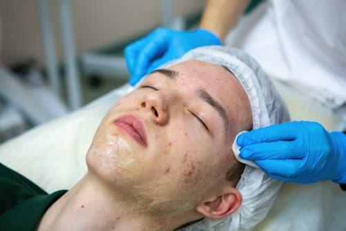 Facials For Acne Prone Skin (Exposed Makes Them Work Better)