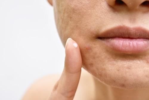 Can Triamcinolone Acetonide Be Used for Acne? (Does It Really Work?)