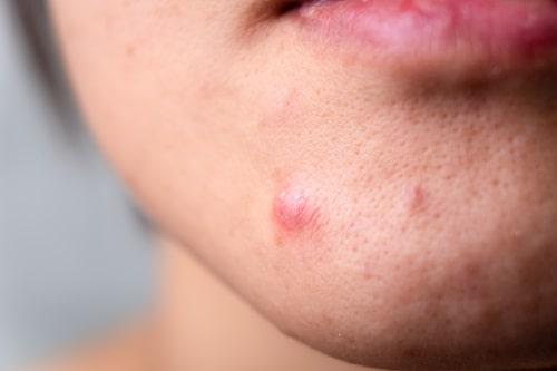 Pustule Acne Treatment (That Works Better With Exposed)