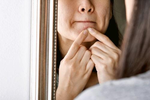 How To Stop Picking Acne (Try This Fix From Exposed)