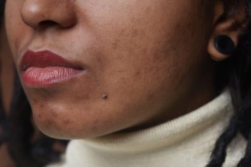 Acne Textured Skin Fix (Actually Works—From Exposed)