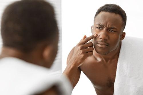 Is Acne Contagious? (Exposed Targets What Causes It)