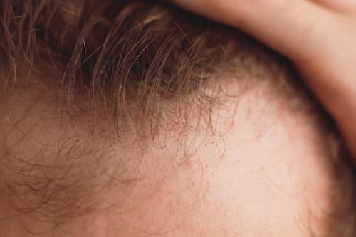 Hairline Acne Breakouts? (Prevent Them With Exposed)