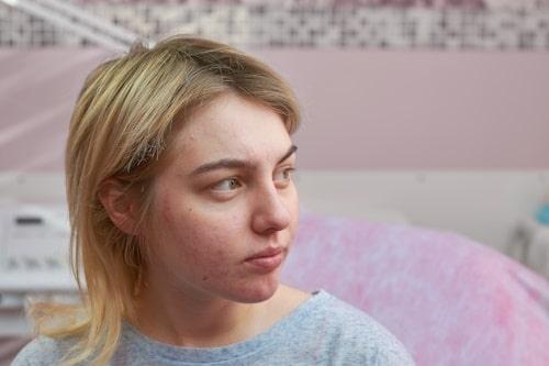 Can Allergies Cause Acne? (Finally Answered)