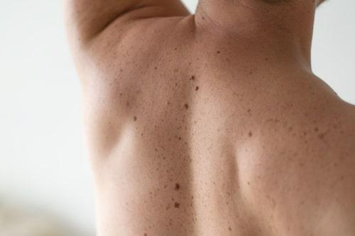 Is Back Acne Hormonal? (Fix It Fast With Exposed)