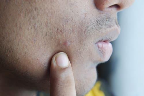 Hair Follicle Acne Vs Folliculitis? (Fix Both With Exposed)