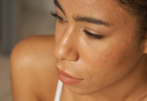 The Ultimate Guide to Fungal Acne Treatment: Say Goodbye to Those Pesky Bumps!