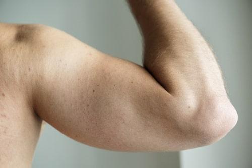 Cystic Acne On Arms? (What Finally Worked Was Exposed)
