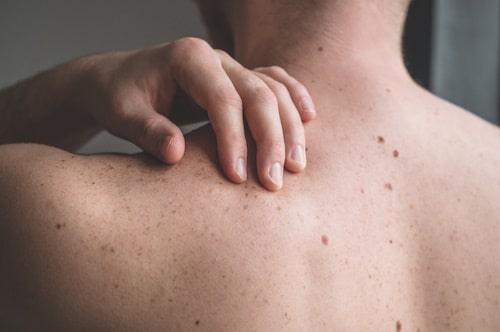 What Causes Back Acne In Males? (Stop It With Exposed)