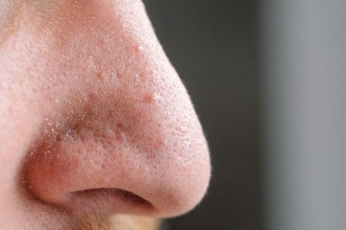 Comedonal Acne Treatment (Best Results With Exposed)