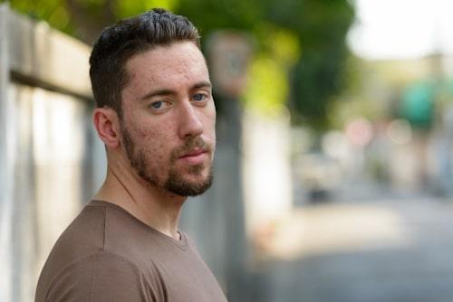 Hormonal Acne in Men (What You Need to Know)