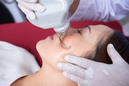 Laser Resurfacing Acne Scars? (Read This From Exposed First)
