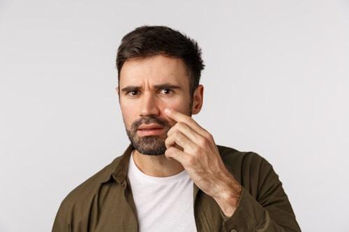 Acne and Hair Loss Relationship (Everything You Need to Know)