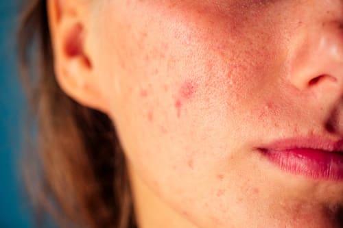 Active Acne Breakouts? (Exposed Calms Them Quickly)