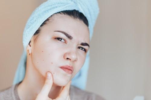 Ingrown Hair Acne Or Breakout? (Fix Both With Exposed)