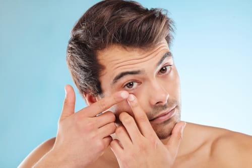 How To Balance Male Hormones For Acne (Try This From Exposed)