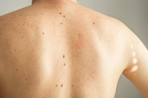 Home Remedies For Back Acne (Exposed Clears It Faster)