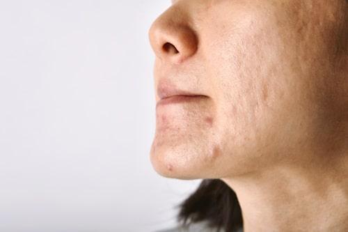 Acne In Your 20s Male? (What Exposed Gets Right Now)