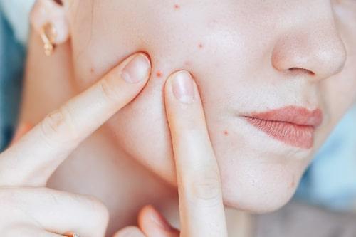 How Long Does It Take For Acne To Go Away? (Exposed Speeds It Up)