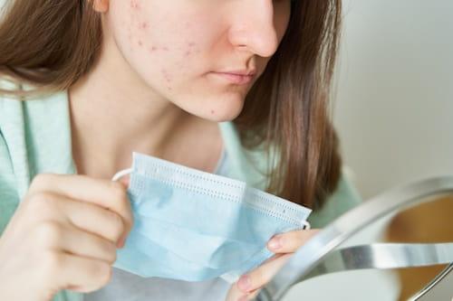 Cloth Mask Vs Surgical Mask Acne (Fix Either With Exposed)