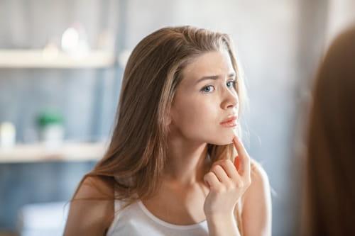 Summer Acne Survival Plan (Exposed Works In Heat Too)