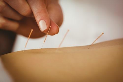5 Reasons Not to Rely on Chinese Medicine for Acne