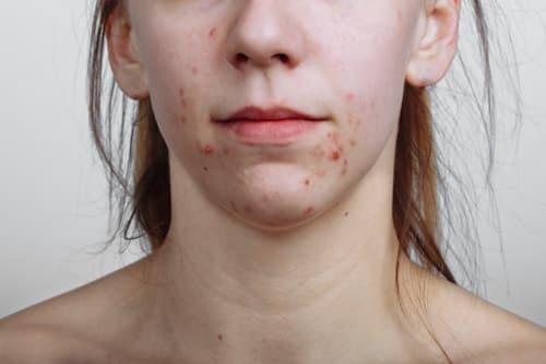 Is Acne An Infection? (Exposed Targets The Root)