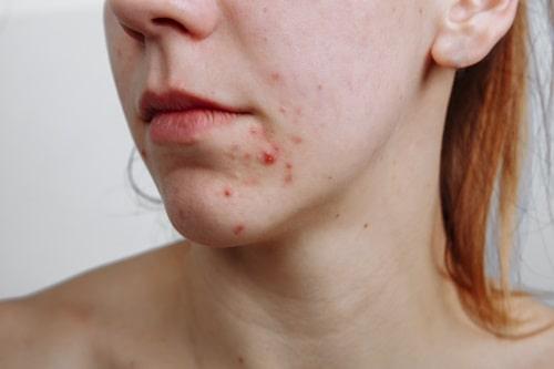 Severe Nodulocystic Acne Treatment (Only Exposed Lasts Long)